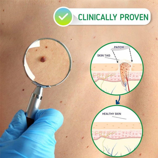 Gentle Wart & Skin Tag Solution