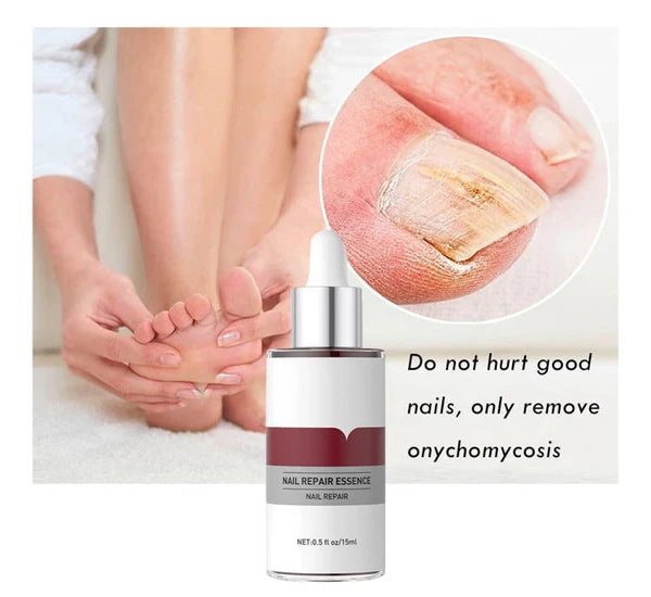 Nail Fungus Buster