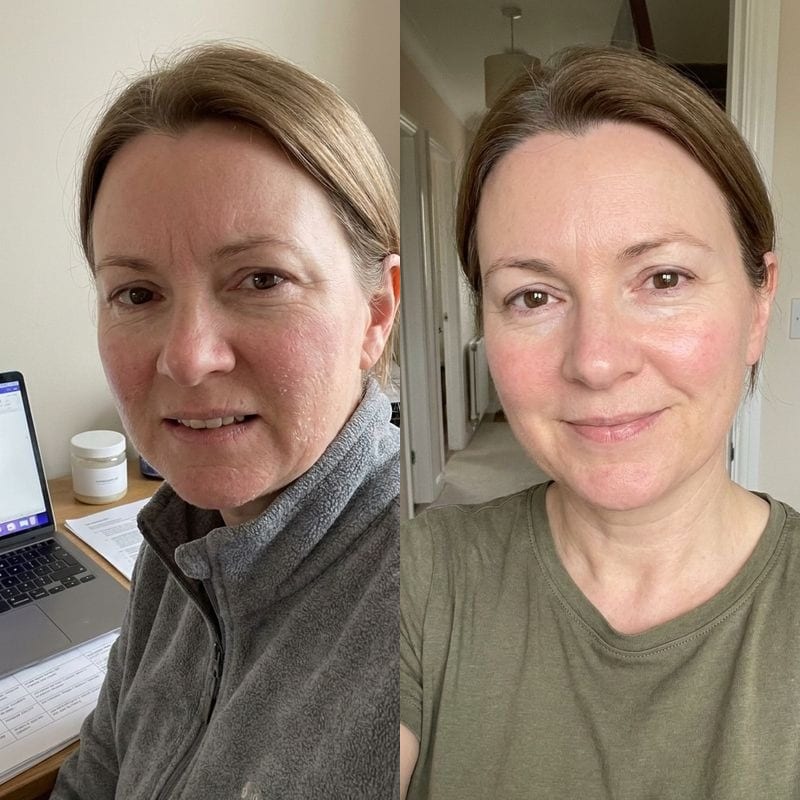 Melissa B. before and after: fine lines looking softer