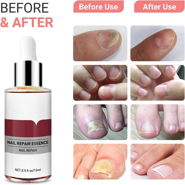 Nail Fungus Buster