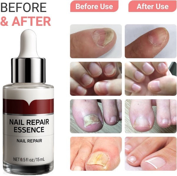 Nail Fungus Buster